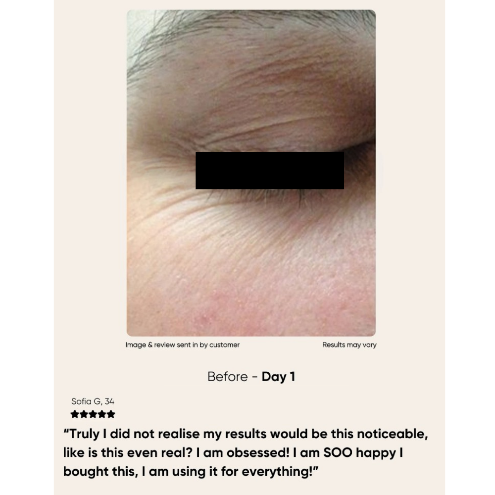 Glowstry RF Facial Lifting & Skin Tightening Machine before