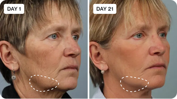 Glowstry Massager’s Ultimate 7-in-1 LED Light Therapy Before and after comparison 2