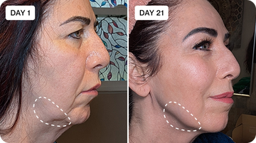Glowstry Massager’s Ultimate 7-in-1 LED Light Therapy Before and after comparison 3