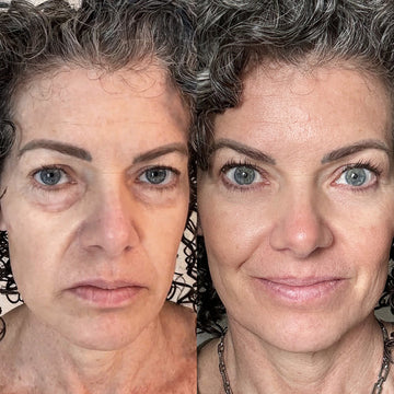 Glowstry™ Under-Eye Red Light Therapy Results5