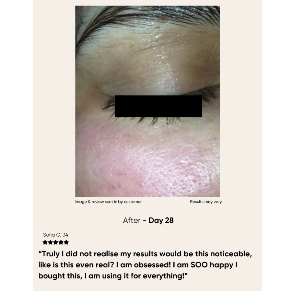 Glowstry RF Facial Lifting & Skin Tightening Machine after