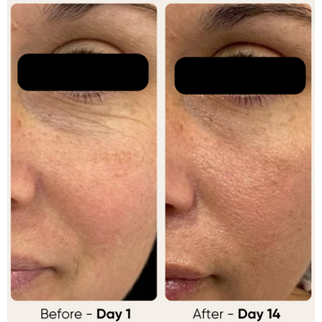 Glowstry RF Facial Lifting & Skin Tightening Machine  Before and after comparison 1