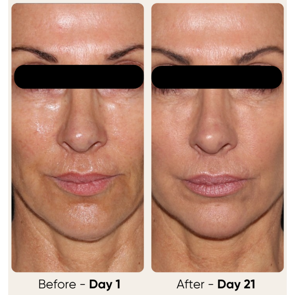 Glowstry RF Facial Lifting & Skin Tightening Machine  Before and after comparison  3