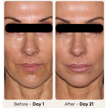 Glowstry RF Facial Lifting & Skin Tightening Machine  Before and after comparison  3
