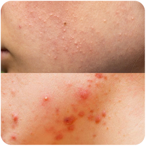 Clogged Pores
