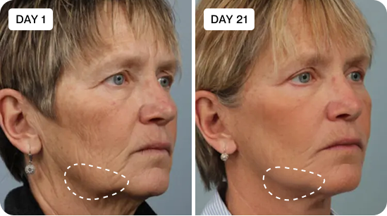 Glowstry Massager’s Ultimate 7-in-1 LED Light Therapy Before and after comparison 2
