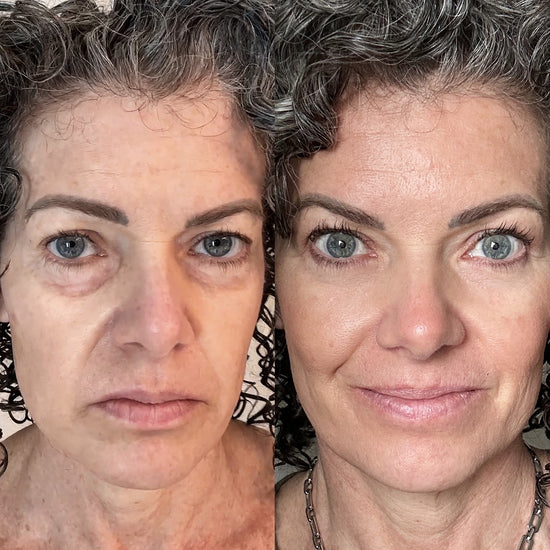 Glowstry™ Under-Eye Red Light Therapy Results5