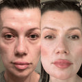 Glowstry™ Under-Eye Red Light Therapy before after