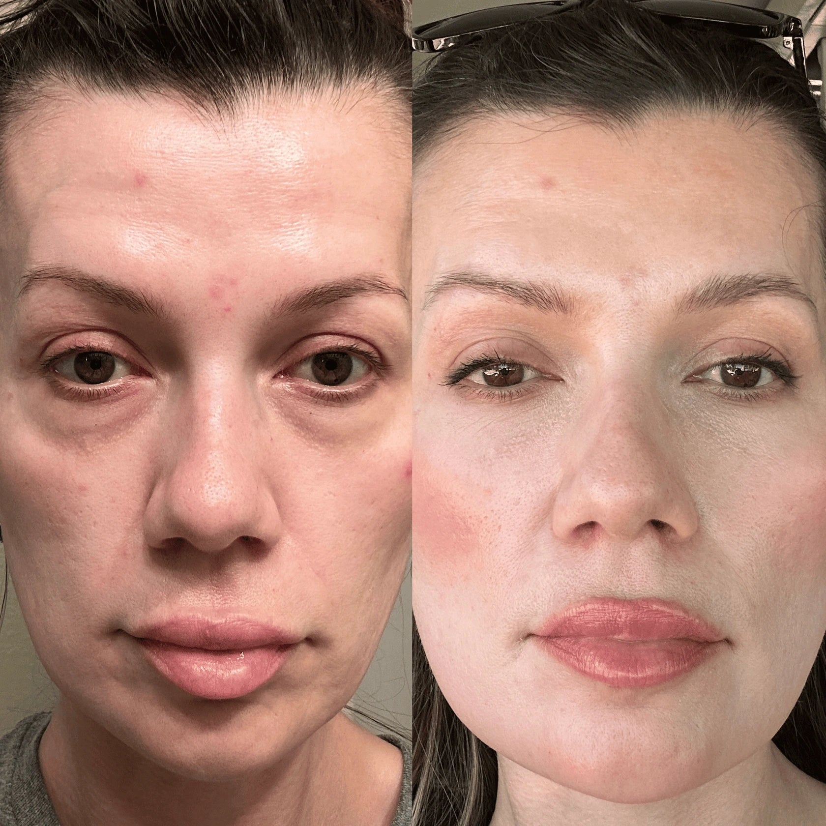 Glowstry™ Under-Eye Red Light Therapy before after