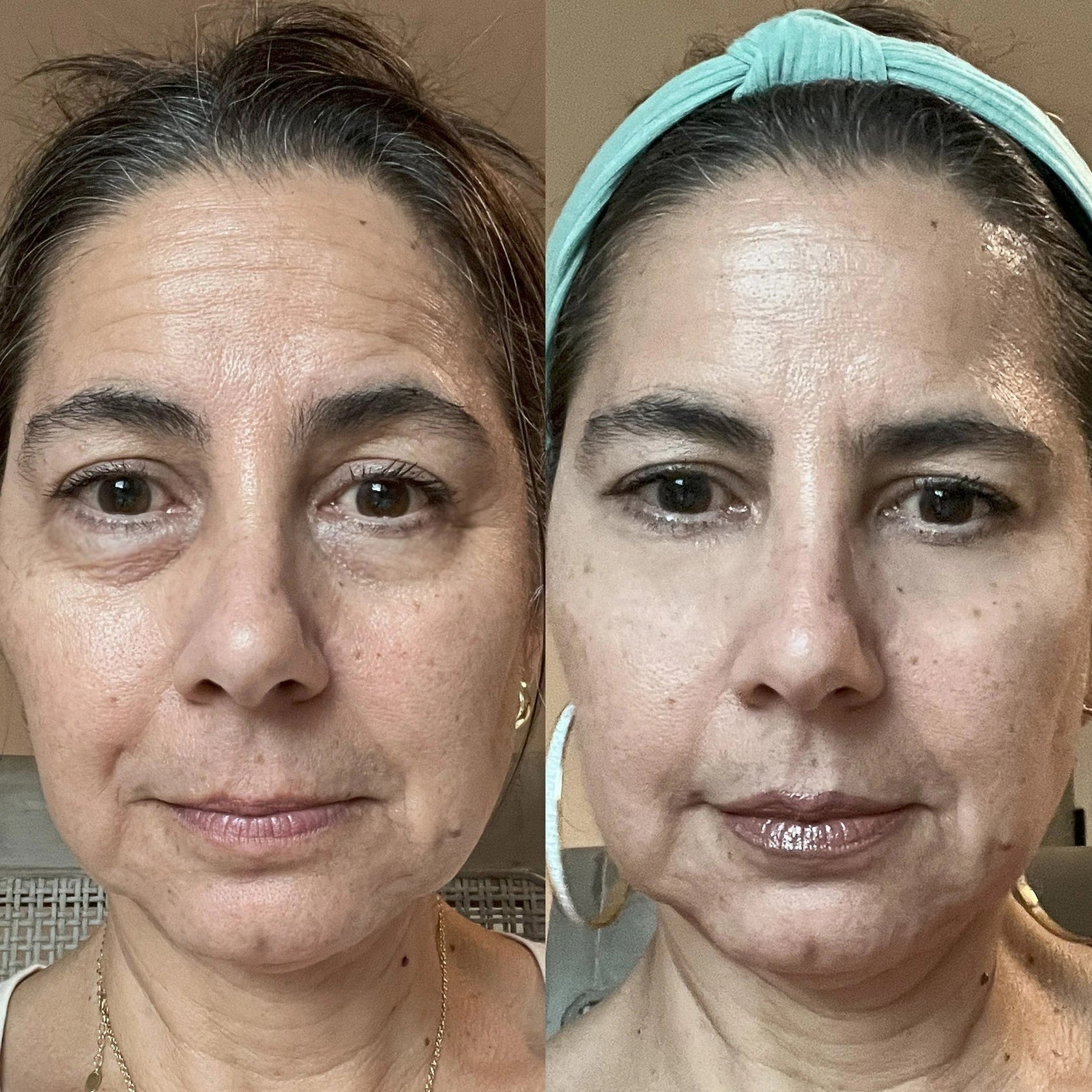 Glowstry™ Under-Eye Red Light Therapy before after1