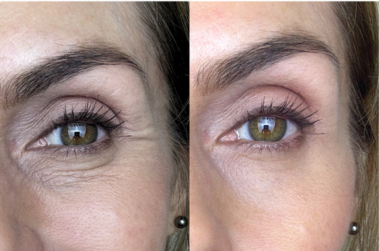 Treat Fine Lines and Wrinkles