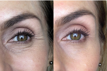 Treat Fine Lines and Wrinkles