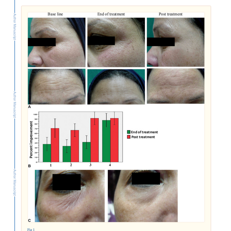 Representative photographs of periorbital and forehead areas at baseline, end of treatment, and 3 months posttreatment