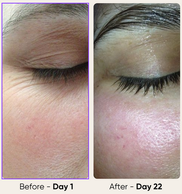 Glowstry RF Facial Lifting & Skin Tightening Machine  Before and after comparison  2
